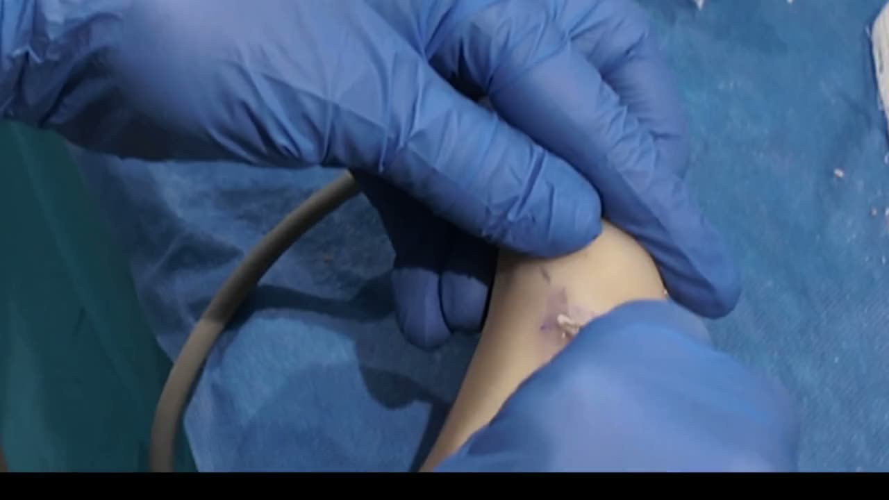 Thumb pressure on the Cadara Foot expressing bone paste from a stab incision